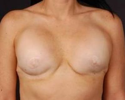 Reconstructive Breast Revision Before & After Gallery - Patient 205783 - Image 1