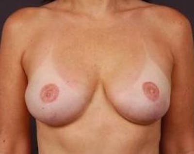 Reconstructive Breast Revision Before & After Gallery - Patient 205783 - Image 2