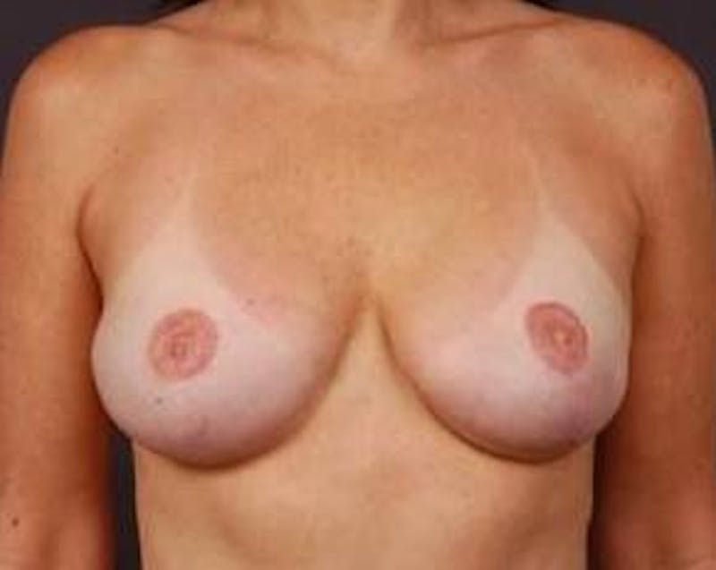 Reconstructive Breast Revision Before & After Gallery - Patient 205783 - Image 2