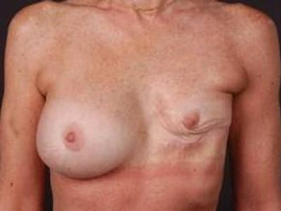 Reconstructive Breast Revision Before & After Gallery - Patient 129838 - Image 1