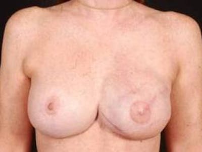 Reconstructive Breast Revision Before & After Gallery - Patient 129838 - Image 2