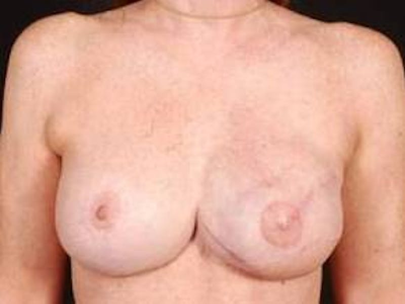 Reconstructive Breast Revision Before & After Gallery - Patient 129838 - Image 2