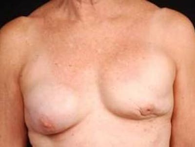 Reconstructive Breast Revision Before & After Gallery - Patient 150834 - Image 1