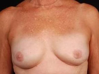 Reconstructive Breast Revision Before & After Gallery - Patient 150834 - Image 2