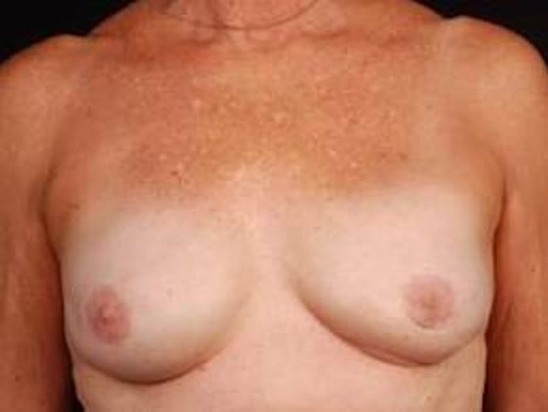 Reconstructive Breast Revision Before & After Gallery - Patient 150834 - Image 2