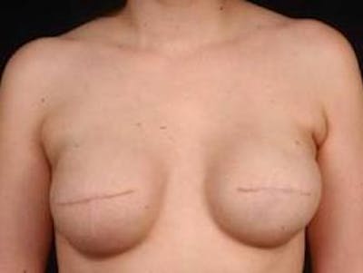 Reconstructive Breast Revision Before & After Gallery - Patient 112376 - Image 1