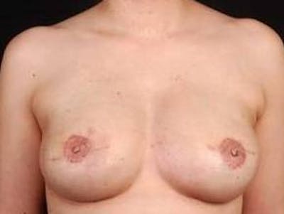 Reconstructive Breast Revision Before & After Gallery - Patient 112376 - Image 2