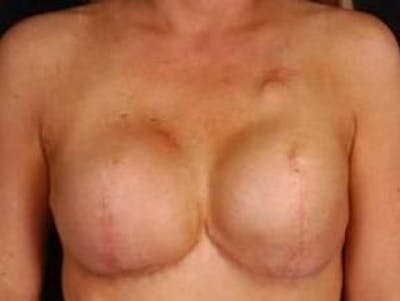 Reconstructive Breast Revision Before & After Gallery - Patient 120405 - Image 1