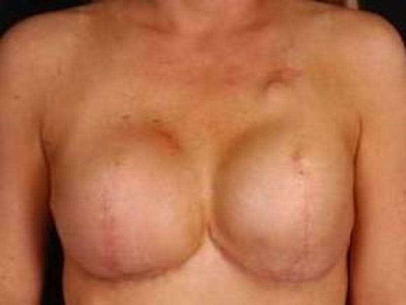 Reconstructive Breast Revision Before & After Gallery - Patient 120405 - Image 1