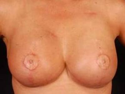 Reconstructive Breast Revision Before & After Gallery - Patient 120405 - Image 2