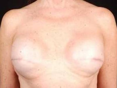 Reconstructive Breast Revision Before & After Gallery - Patient 358529 - Image 1