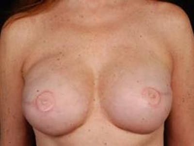 Reconstructive Breast Revision Before & After Gallery - Patient 358529 - Image 2
