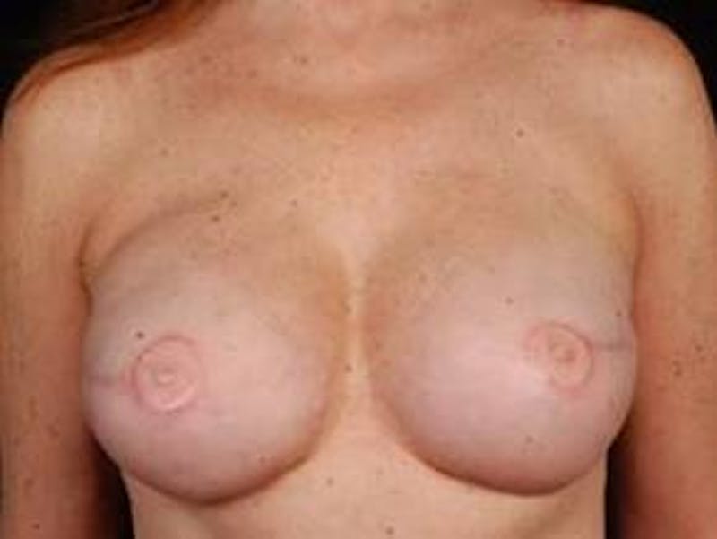 Reconstructive Breast Revision Before & After Gallery - Patient 358529 - Image 2