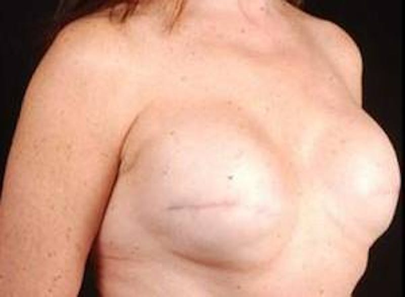 Reconstructive Breast Revision Before & After Gallery - Patient 358529 - Image 5