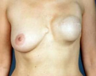 Reconstructive Breast Revision Before & After Gallery - Patient 149049 - Image 1