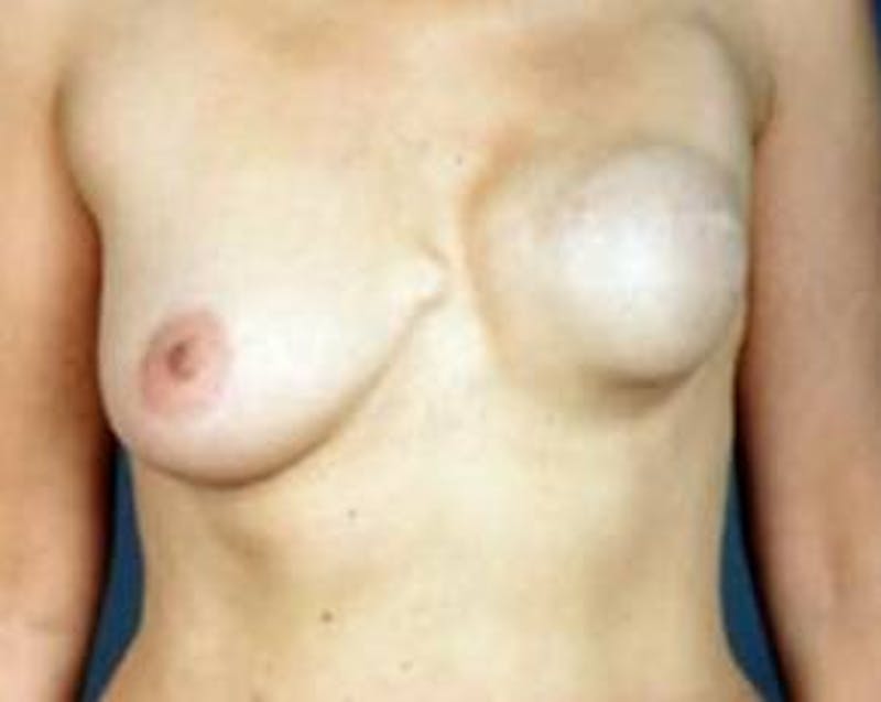 Reconstructive Breast Revision Before & After Gallery - Patient 149049 - Image 1