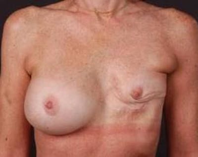 Reconstructive Breast Revision Before & After Gallery - Patient 161874 - Image 1