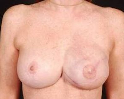 Reconstructive Breast Revision Before & After Gallery - Patient 161874 - Image 2