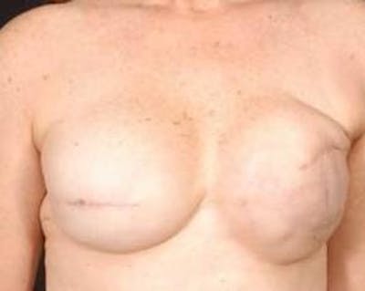 Reconstructive Breast Revision Before & After Gallery - Patient 117846 - Image 1
