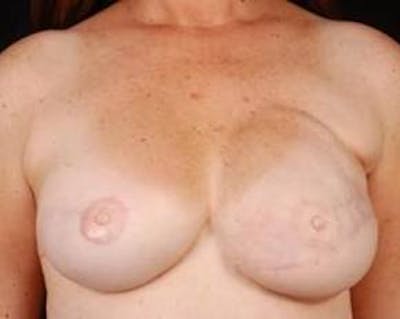 Reconstructive Breast Revision Before & After Gallery - Patient 117846 - Image 2