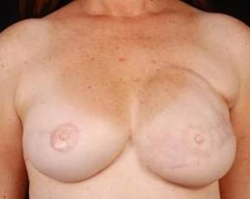 Reconstructive Breast Revision Before & After Gallery - Patient 117846 - Image 2