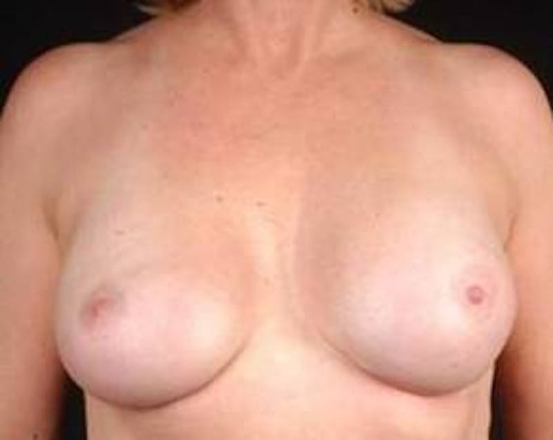 Reconstructive Breast Revision Before & After Gallery - Patient 355816 - Image 2