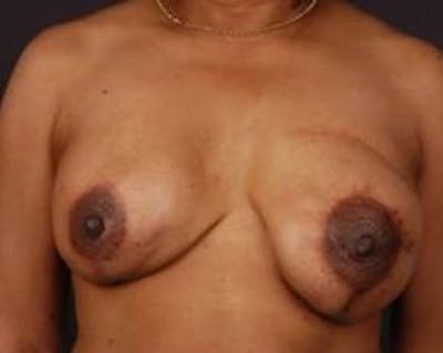 Reconstructive Breast Revision Before & After Gallery - Patient 281669 - Image 1
