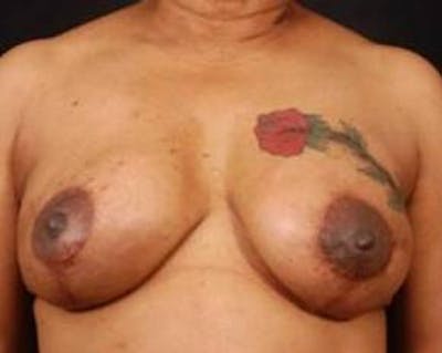 Reconstructive Breast Revision Before & After Gallery - Patient 281669 - Image 2