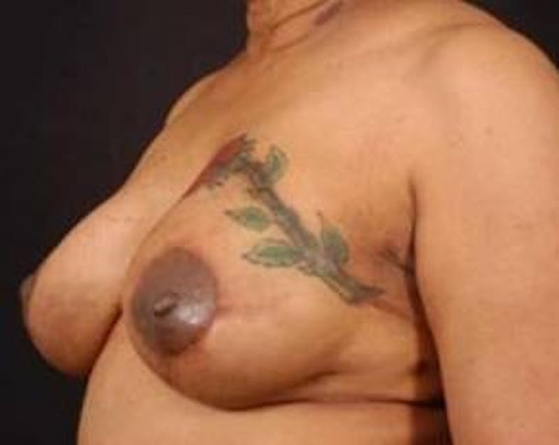 Reconstructive Breast Revision Before & After Gallery - Patient 281669 - Image 4
