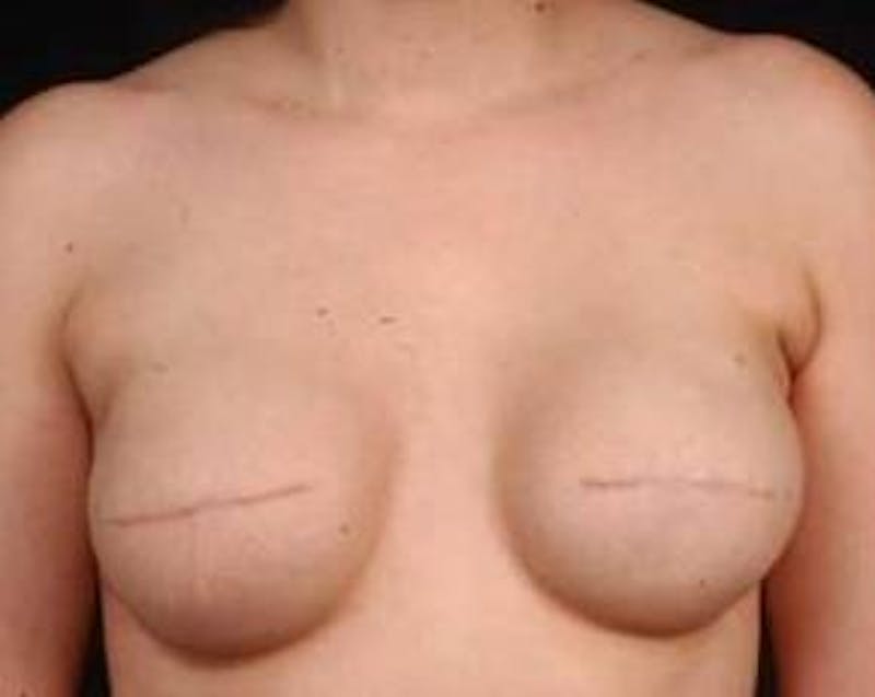 Reconstructive Breast Revision Before & After Gallery - Patient 926773 - Image 1