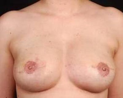 Reconstructive Breast Revision Before & After Gallery - Patient 926773 - Image 2
