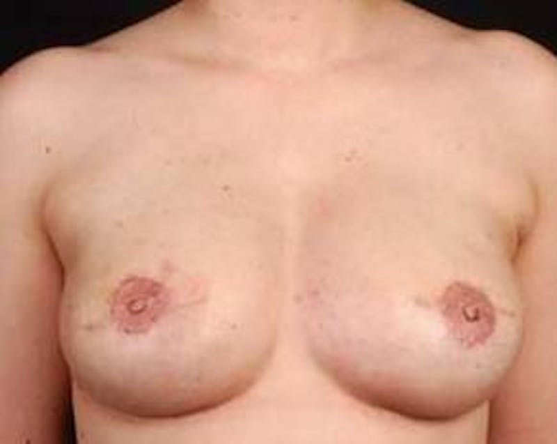 Reconstructive Breast Revision Before & After Gallery - Patient 926773 - Image 2