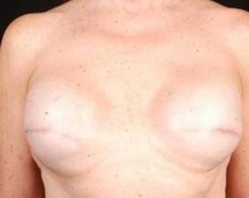 Reconstructive Breast Revision Before & After Gallery - Patient 213137 - Image 1