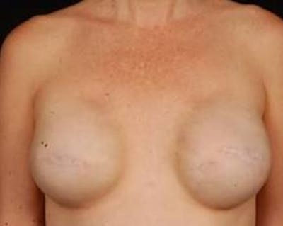 Reconstructive Breast Revision Before & After Gallery - Patient 345351 - Image 1