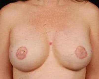 Reconstructive Breast Revision Before & After Gallery - Patient 345351 - Image 2
