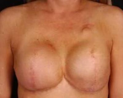Reconstructive Breast Revision Before & After Gallery - Patient 368508 - Image 1