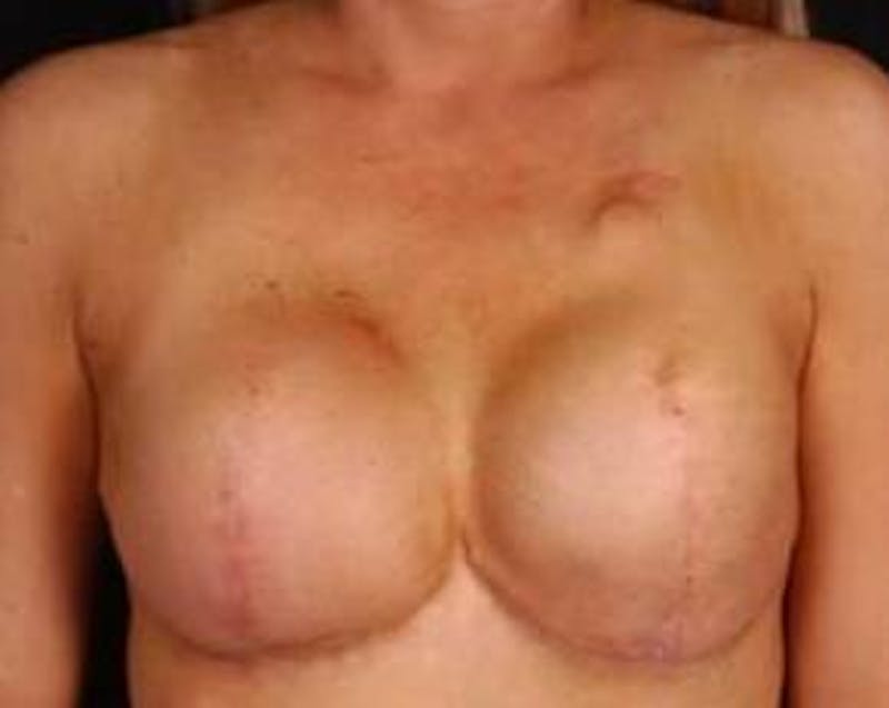 Reconstructive Breast Revision Before & After Gallery - Patient 368508 - Image 1