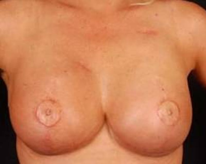 Reconstructive Breast Revision Before & After Gallery - Patient 368508 - Image 2