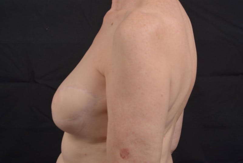 Reconstructive Breast Revision Before & After Gallery - Patient 214918 - Image 3