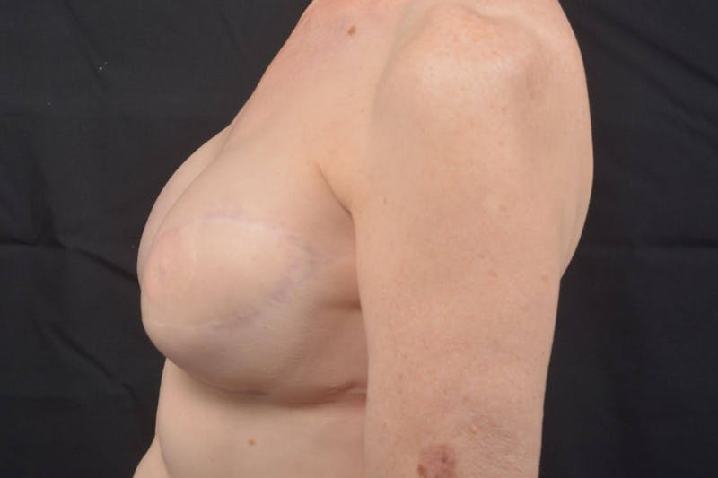 Reconstructive Breast Revision Before & After Gallery - Patient 214918 - Image 4