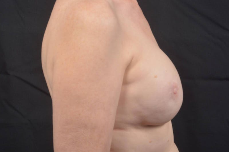 Reconstructive Breast Revision Before & After Gallery - Patient 214918 - Image 6