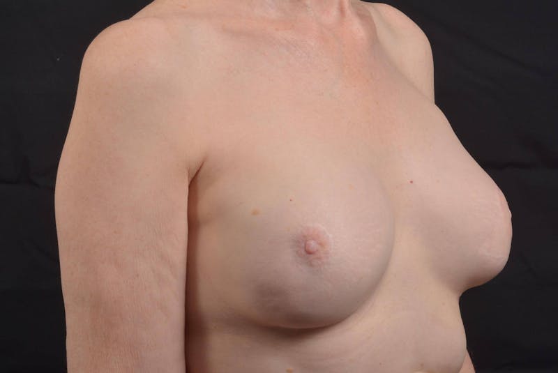 Reconstructive Breast Revision Before & After Gallery - Patient 214918 - Image 9