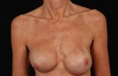 Reconstructive Breast Revision Before & After Gallery - Patient 155176 - Image 1