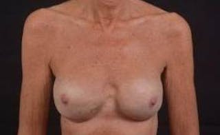 Reconstructive Breast Revision Before & After Gallery - Patient 155176 - Image 2