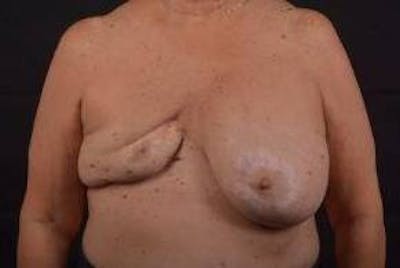 Reconstructive Breast Revision Before & After Gallery - Patient 347729 - Image 1
