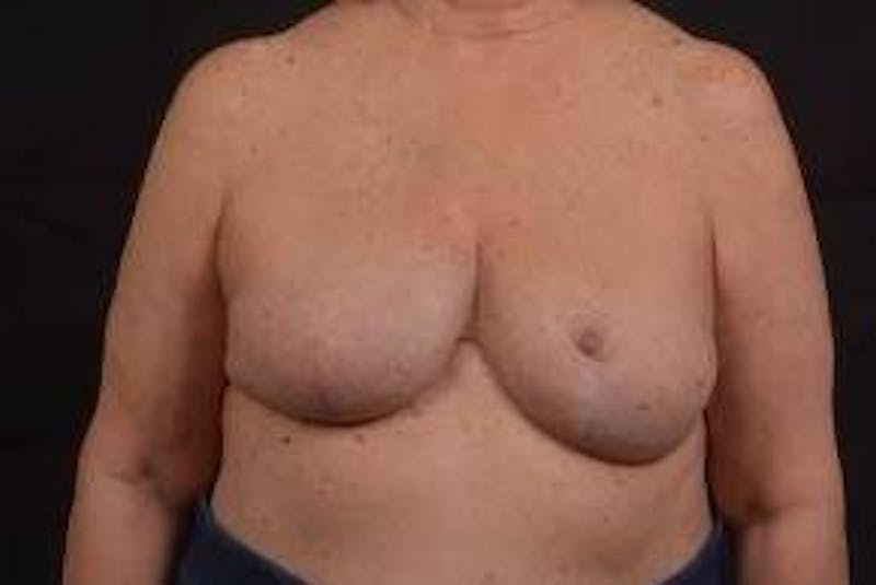 Reconstructive Breast Revision Before & After Gallery - Patient 347729 - Image 2
