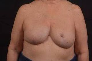 Reconstructive Breast Revision Before & After Gallery - Patient 347729 - Image 2