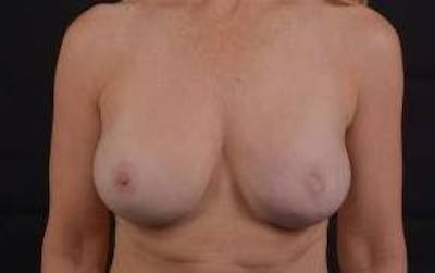 Reconstructive Breast Revision Before & After Gallery - Patient 122768 - Image 1