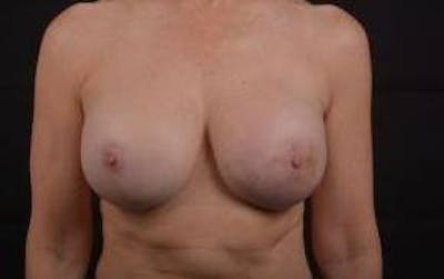 Reconstructive Breast Revision Before & After Gallery - Patient 122768 - Image 2