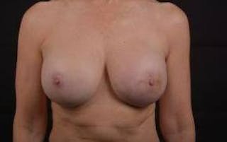 Reconstructive Breast Revision Before & After Gallery - Patient 122768 - Image 2
